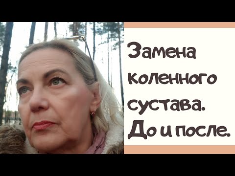 Замена коленного сустава. До и после.