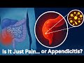 Appendicitis Explained: Causes, Symptoms & Treatment | Simple Health Guide