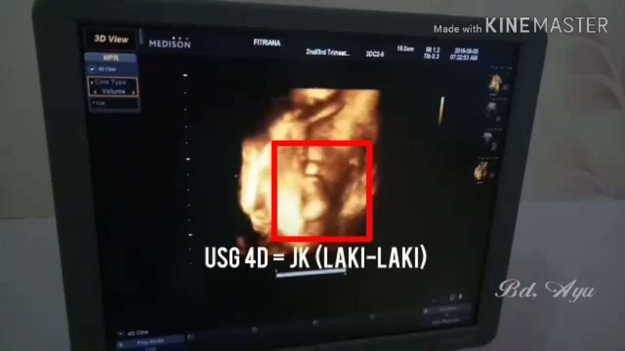 25 Contractions at 34 weeks Pregnancy USG 2D & 4D YouTube