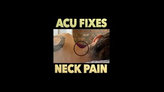 Download lagu How an Acupuncturist Treats Neck Pain