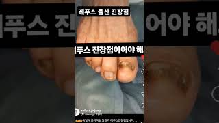#내성발톱 #IngrownToenail #ToenailCare #FootCare #NailCare #FootHealth #巻き爪 #陥入爪 #MongQuap #ChamSocChan