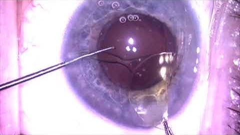 IOL exchange with Reverse Optic Capture for Negative Dysphotopsia by Steven G. Safran MD