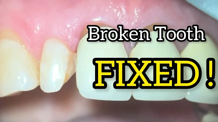 Class IV Composite Restoration | Step-by-Step Anterior Tooth Build-Up