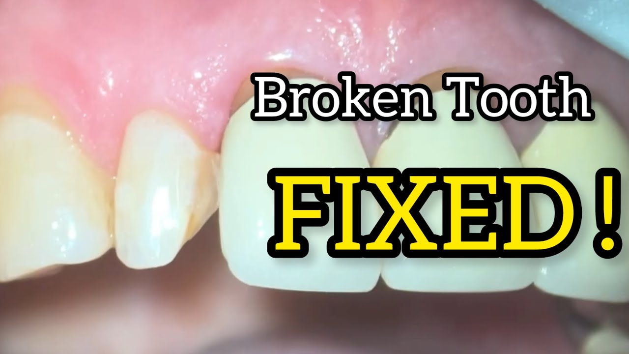 Class IV Composite Restoration | Step-by-Step Anterior Tooth Build-Up