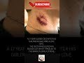 A kiss that turned deadly. 💔 Watch how a simple hickey led to a tragic stroke. #Shorts #TrueStory"