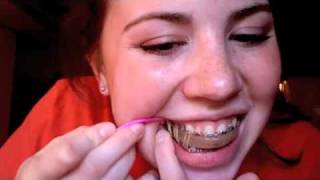 TMJ Surgical Splint Demo (Part 2)