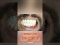 Dental lab work Rpd #shortsfeed #viralvideo