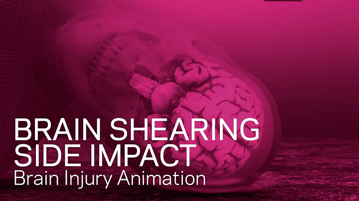 Brain shearing from side impact