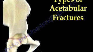 Acetabular Fractures - Everything You Need To Know - Dr. Nabil Ebraheim