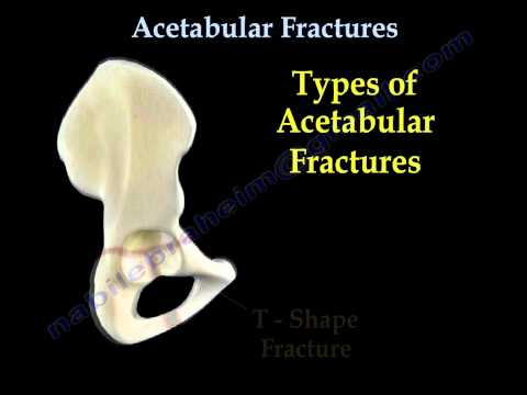 Video: Apakah fraktur asetabular?