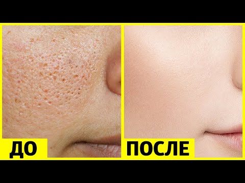КАК ИЗБАВИТЬСЯ ОТ БОЛЬШИХ ПОР И ПОЛУЧИТЬ ГЛАДКУЮ КОЖУ ЗА НЕДЕЛЮ