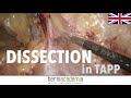 Tapp full  how to dissect in laparoscopic groin hernia repair 