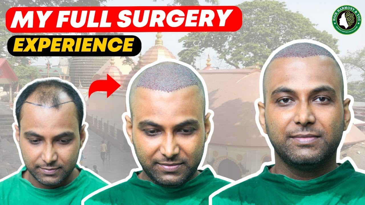 Guwahati's Most Incredible Hair Transplant Story with Hair Harmony