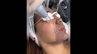 Carbon laser Peel for open pores and acne scars olimpiacarmen  hollywoodpeel laserexperts r