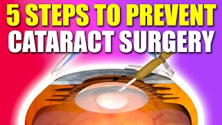 5 Steps to PREVENT Cataract Surgery - 2024