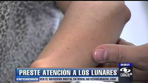 ¿Por qué de repente me salen lunares?