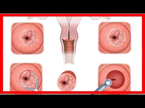 Video: Zervizitis - Zervixerosion Und Zervizitis, Ursachen Und Behandlung