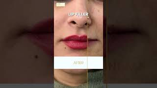 Skinisma Aesthetics | Lip Fillers: Before-After