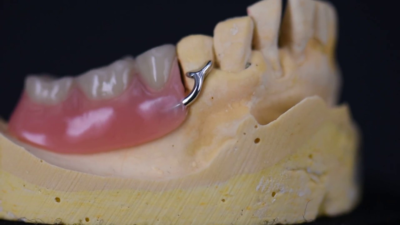 Lower Partial Denture Design