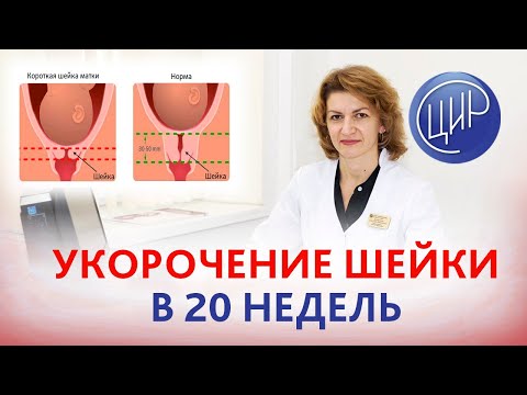 Укорочение шейки матки. В 20 недель беременности шейка матки может укоротиться? Дементьева С.Н.