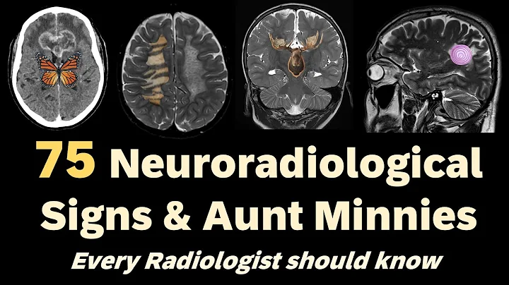 75 Neuroradiological Signs every Radiologist should know!