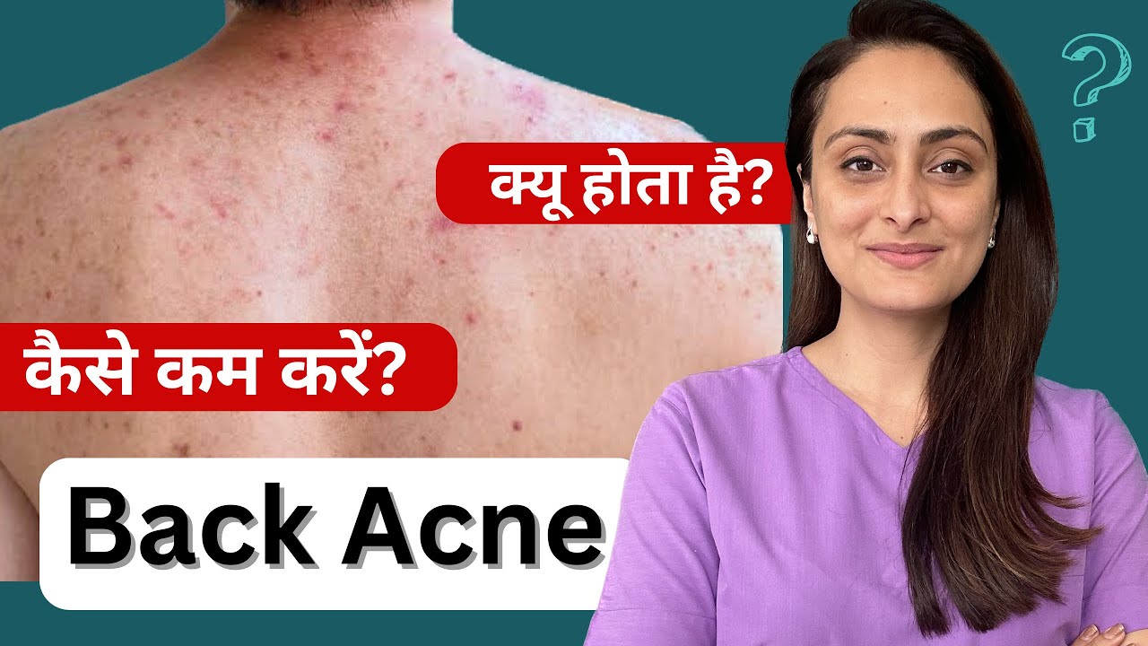 Back acne | क्यूँ होता है | कैसे ठीक करे |  त्वचा के डॉक्टर का सुझाव