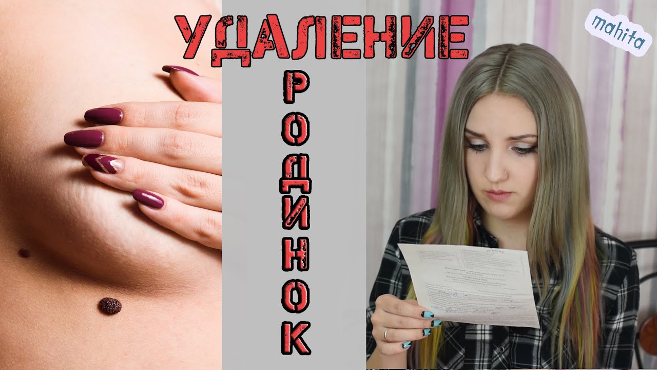 Анализы для удаления родинки