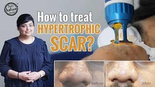 Hypertrophic scar#acnescars are the breakouts of acne, and they leave
#skin into a bothersome condition. there different types acne scars
like atr...