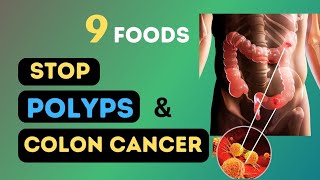 9 Miracle Foods to Eliminate Colon Polyps & Stop Bowel Cancer 9 Foods To Eliminate Colon Polyps And Prevent Bowel Cancer