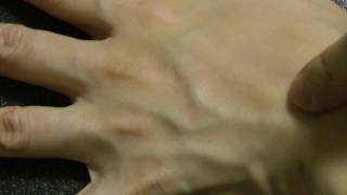 Action of valves in a vein of a human hand.mp4