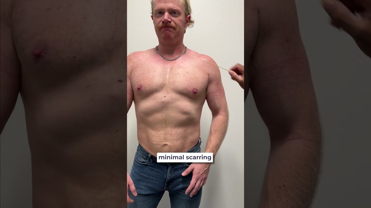 Male Chest Liposuction 6 weeks post op