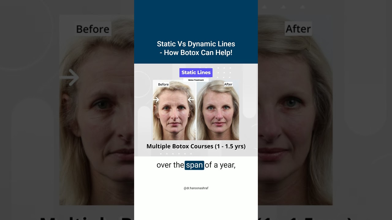 Static Vs Dynamic Lines - How Botox Can Help!