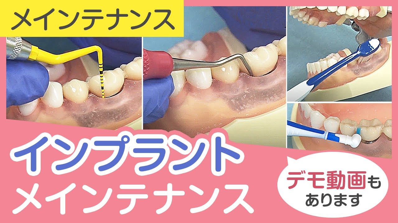 インプラントメインテナンス