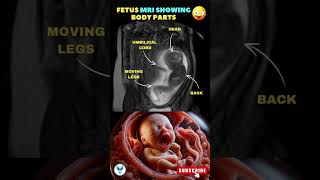 Baby MRI ❤️ Baby growth in the fetus | Tracking baby in the fetus pregnancy trending scan shorts