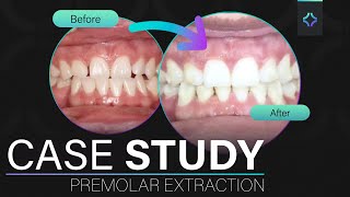 Premolar Extraction with Invisalign - Incredible Transformation & Case Study