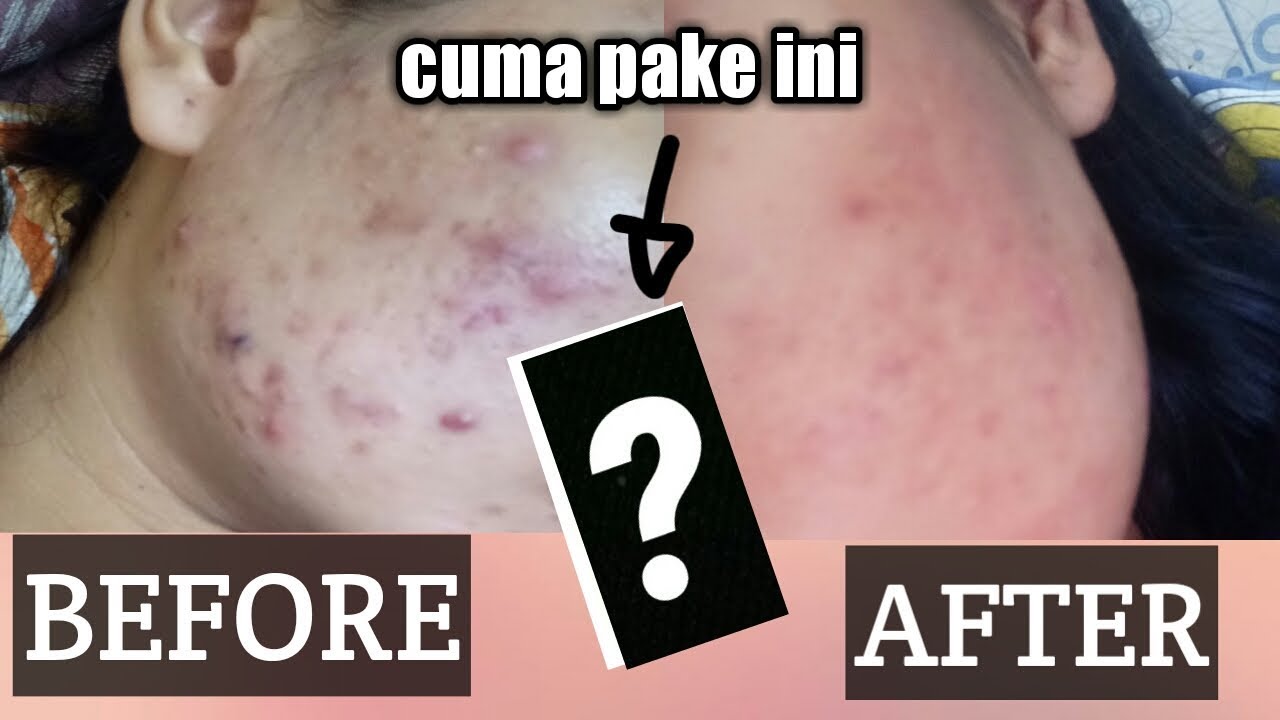 CARA AMPUH MENGHILANGKAN BEKAS JERAWAT 