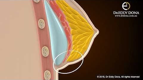 Implant Pockets - Dual Plane Type 1