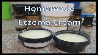 Homemade Eczema Cream