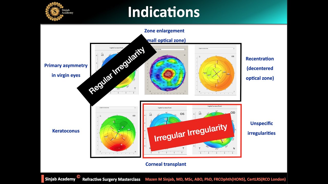 Платформа рефракционной хирургии: новости о персонализированной лазерной коррекции зрения