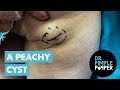 A Peachy Cyst On Her Butt! Dr Pimple Popper Relaxes Nervous Patient