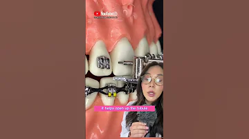 Attaching Braces Bracket Braces Brackets Orthodontics Dentist 