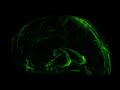 A Brain Drainage System