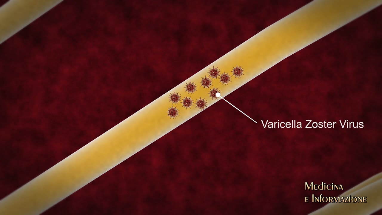 Herpes Zoster (Fuoco di Sant'Antonio)  nuovo vaccino efficace e duraturo anche negli anziani