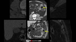 Small bowel diverticulitis