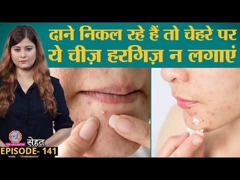 Acne, Pimples, दानों को बिना निशान ठीक करना है तो ये गलतियां ना करें | Sehat ep 141