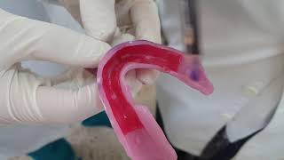 Visit 2: Trimming lower special tray: anterior lingual sulcus area- tray adjustments.