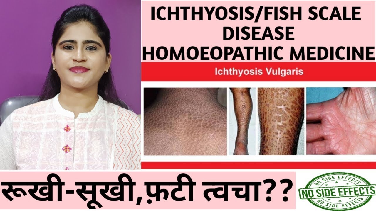 Ichthyosis