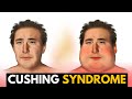 Cushing Syndrome, Causes, Signs and Symptoms, Diagnosis and Treatment.