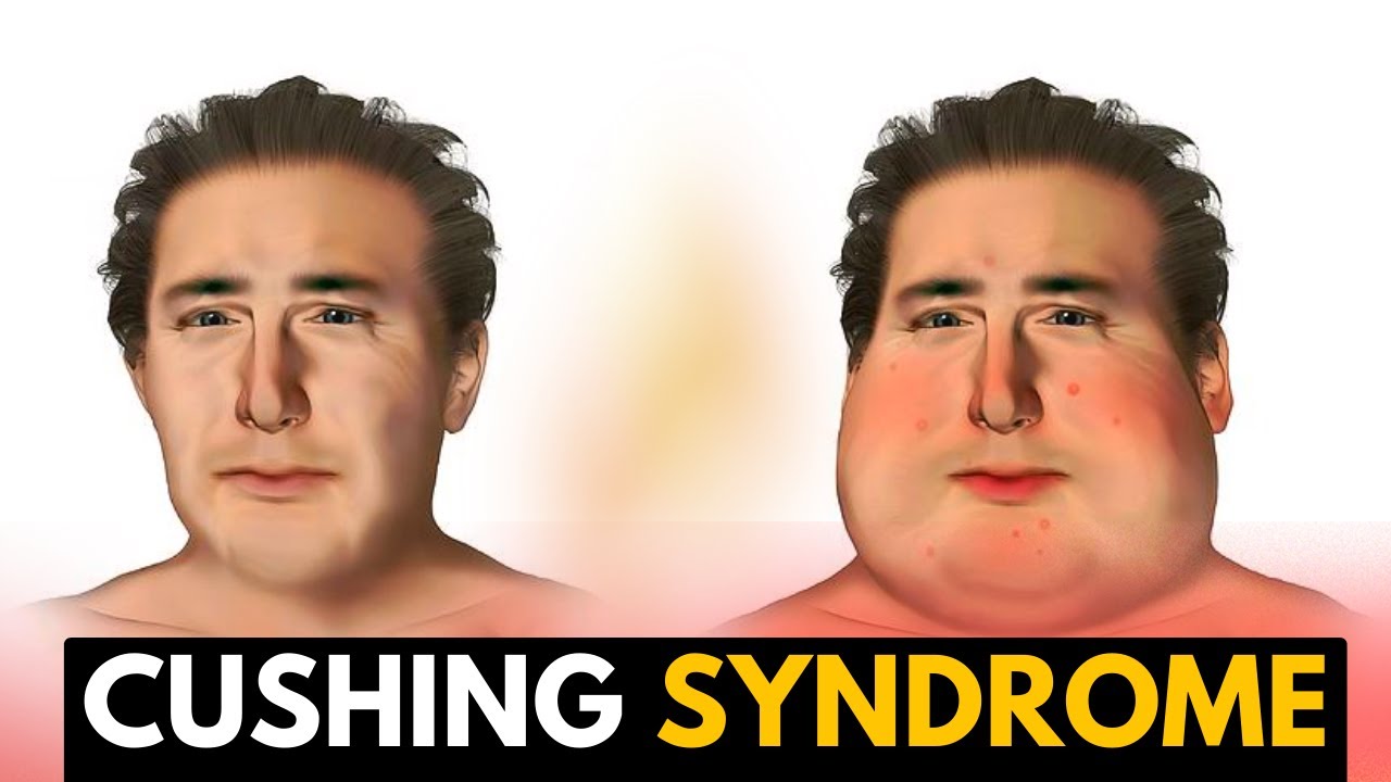 Cushing Syndrome, Causes, Signs and Symptoms, Diagnosis and Treatment