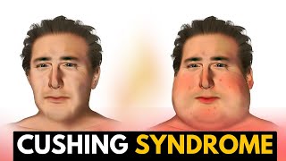 Cushing Syndrome, Causes, Signs and Symptoms, Diagnosis and Treatment.